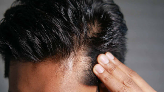 uomo con diradamento di capelli