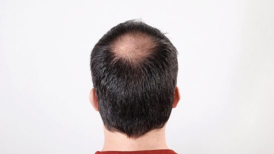 Combattere la Caduta dei Capelli